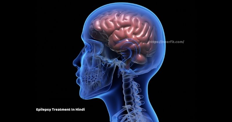 Epilepsy Treatment in Hindi